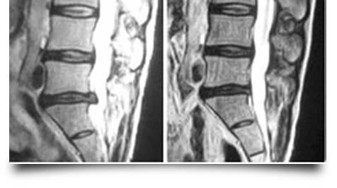 Laser Enhanced Spinal Decompression Douglas, Cork