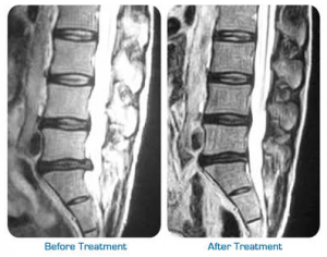 spinal-decompression